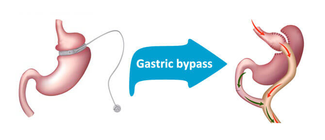 Gyomorgyűrű-bypass átalakítás